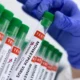 Secretaria de Saúde confirma um novo caso de monkeypox